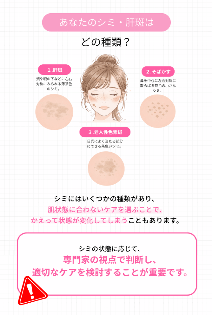シミの種類（肝斑・そばかす・老人性色素斑）を説明したイラスト